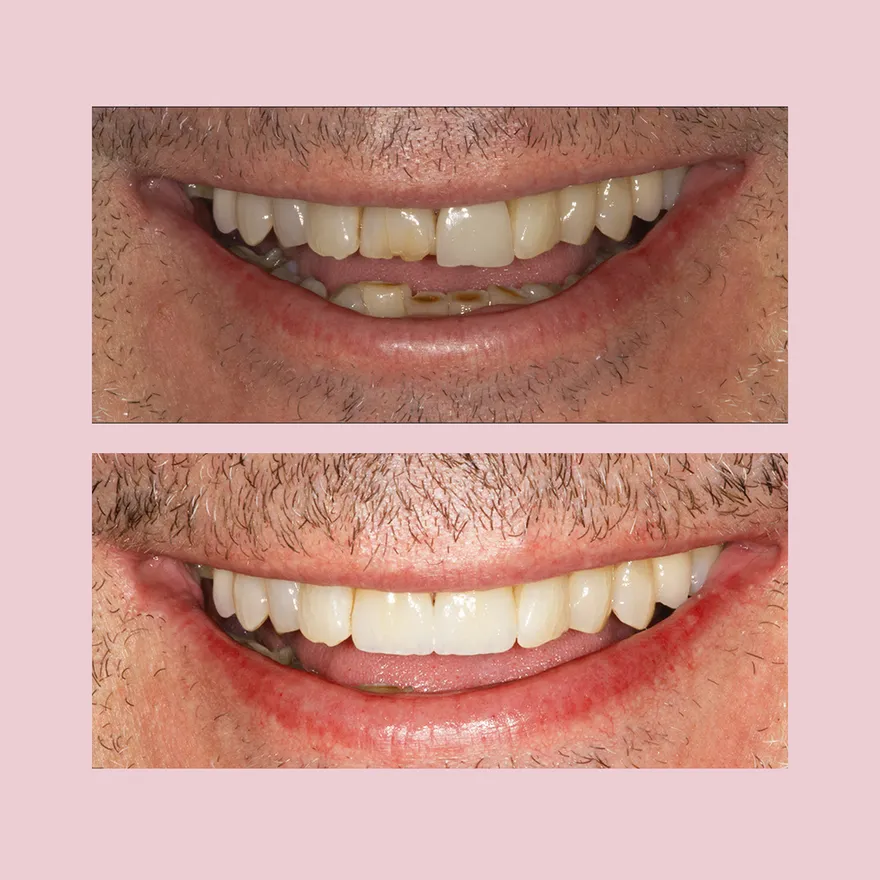 Veneers