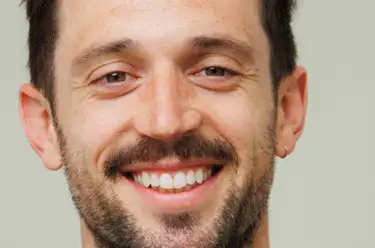 Composite Bonding Vs Veneers Image