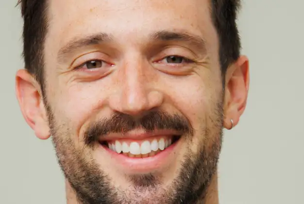 Invisalign treatment - before and after 
