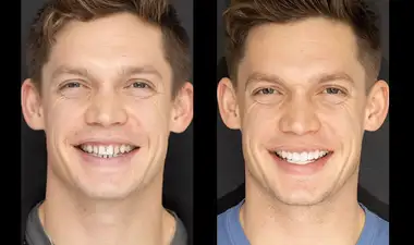 Composite Veneers Image