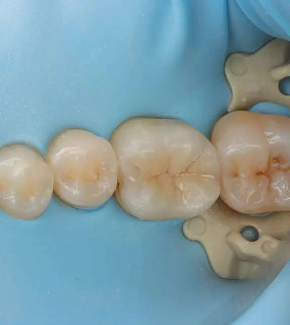 Tooth following restoration