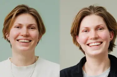 How Long Does Composite Bonding Last? Image