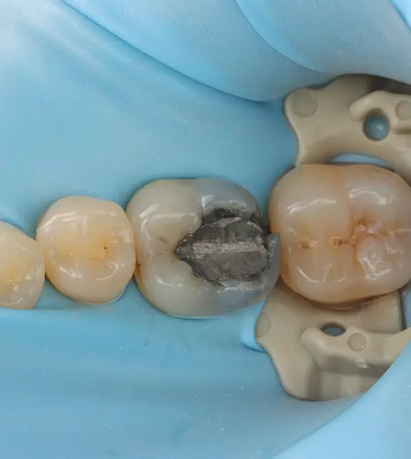 Tooth under rubber dam before treatment