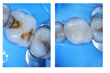 Why Are White Fillings So Expensive? Image