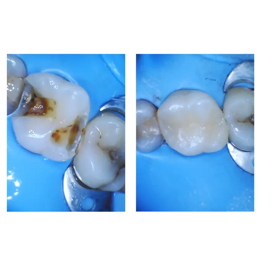 White Fillings