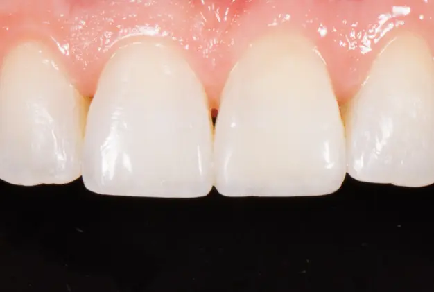 Ceramic Braces Aftercare Advice