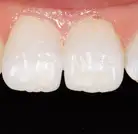 New Teeth