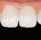 New Teeth