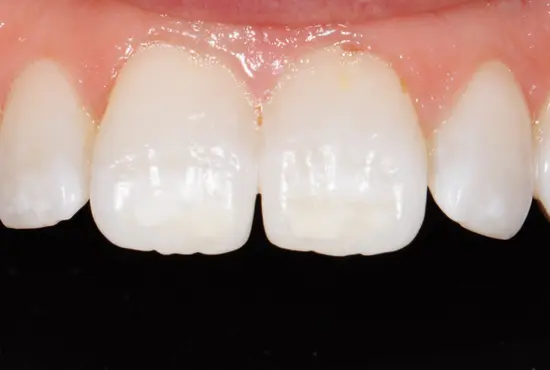 teeth whitening after