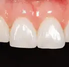 bonding after - close-up - Laura - The Modern Dentist