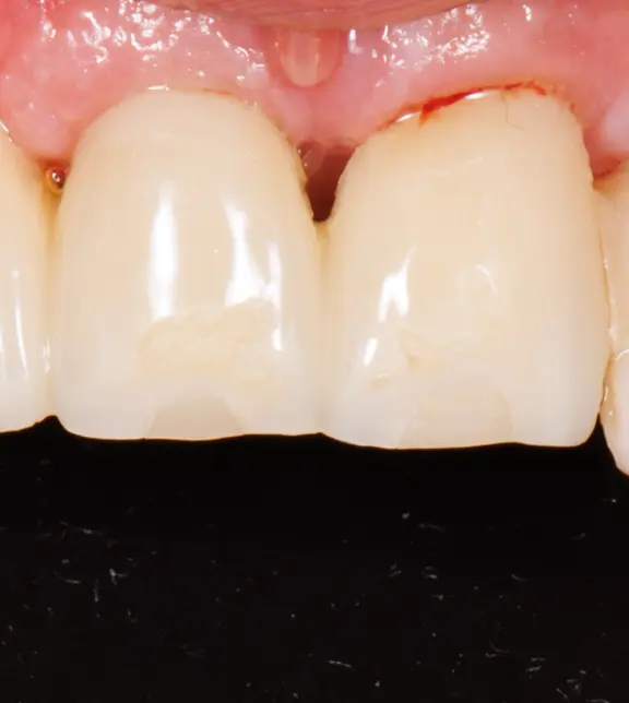 Before treatment