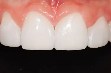 Composite Bonding vs Edge Bonding Image
