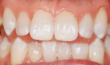 whitening after - close-up - Tom P - The Modern Dentist