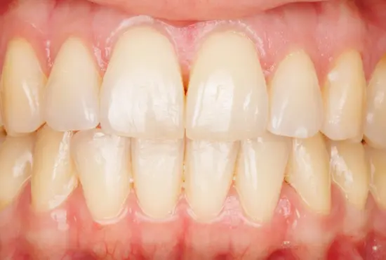 lingual braces - the modern dentist shoreditch