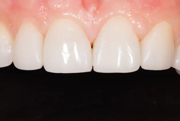 bonding after - close-up - Anna - The Modern Dentist