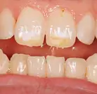 whitening before - close up - Tom P - The Modern Dentist
