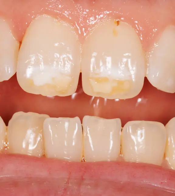 Close-up Before whitening - Tom Partridge - The Modern Dentist
