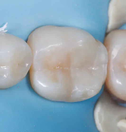 Tooth After Treatment