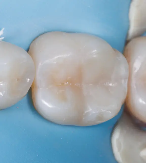Tooth After Treatment