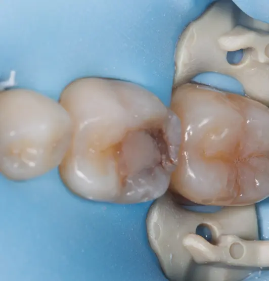 Tooth Before Treatment