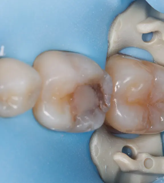 Tooth Before Treatment