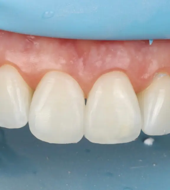 The teeth after treatment