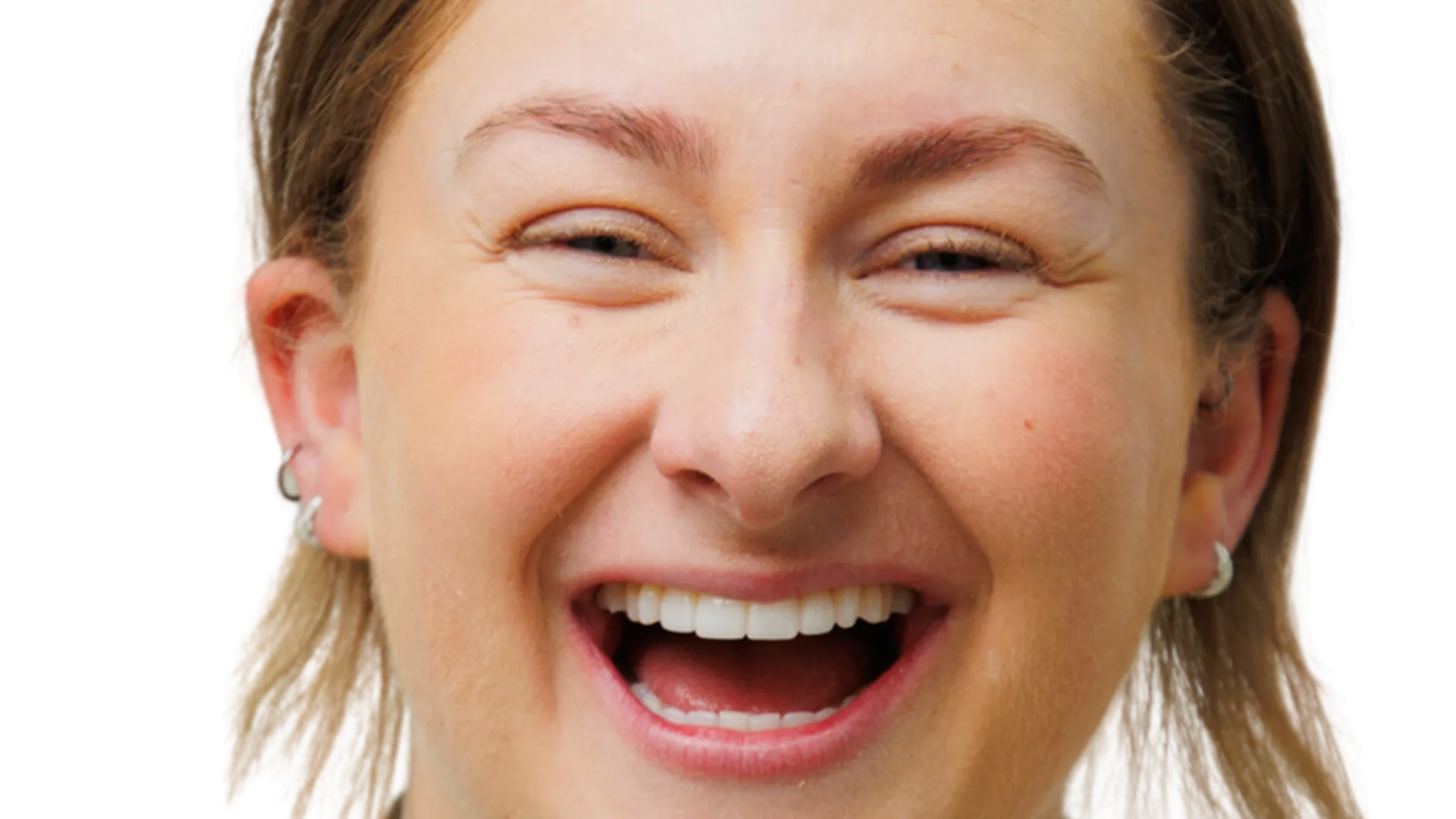 what is composite bonding - the modern dentist