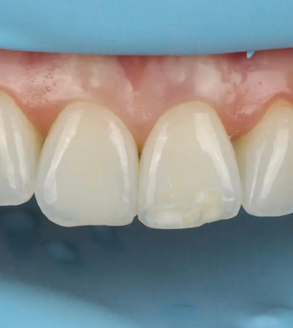The central incisors before treatment