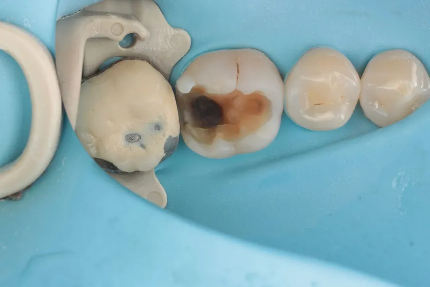 White Fillings Before