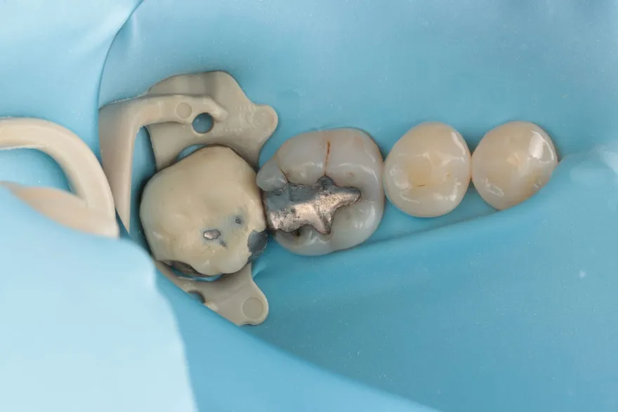 White Fillings After