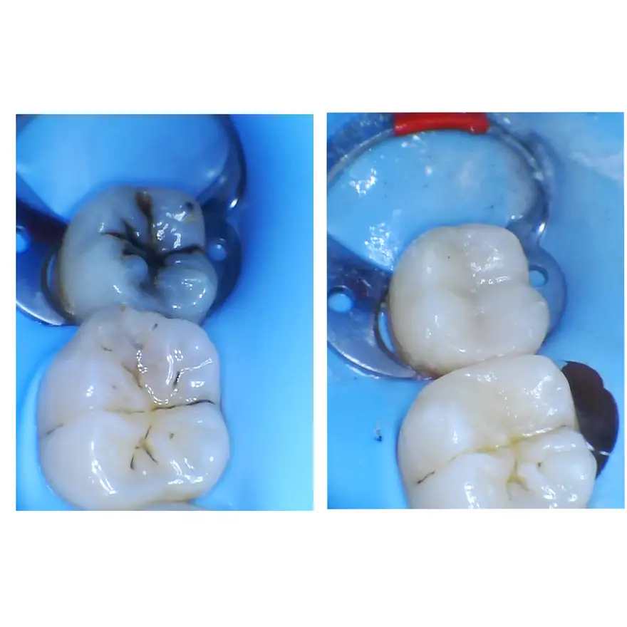 White Fillings