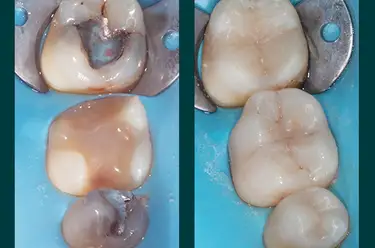 White Fillings Before and After: What to Expect Image