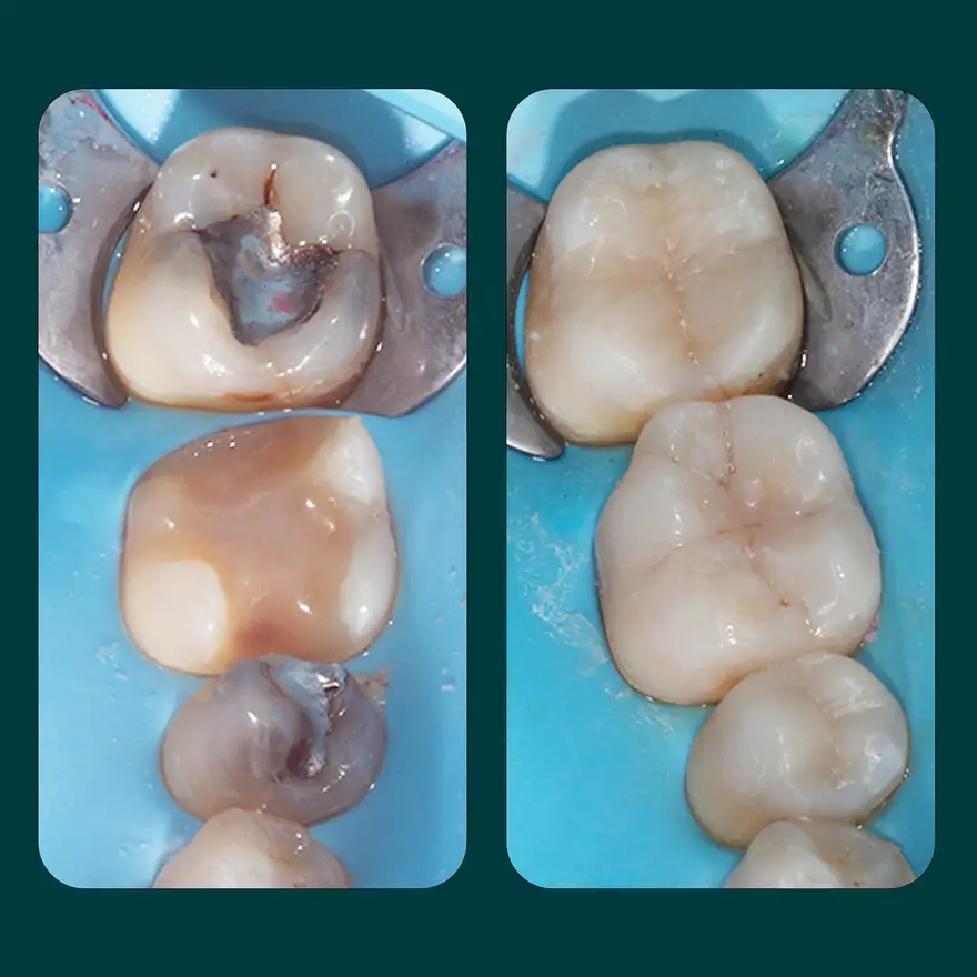Amalgams