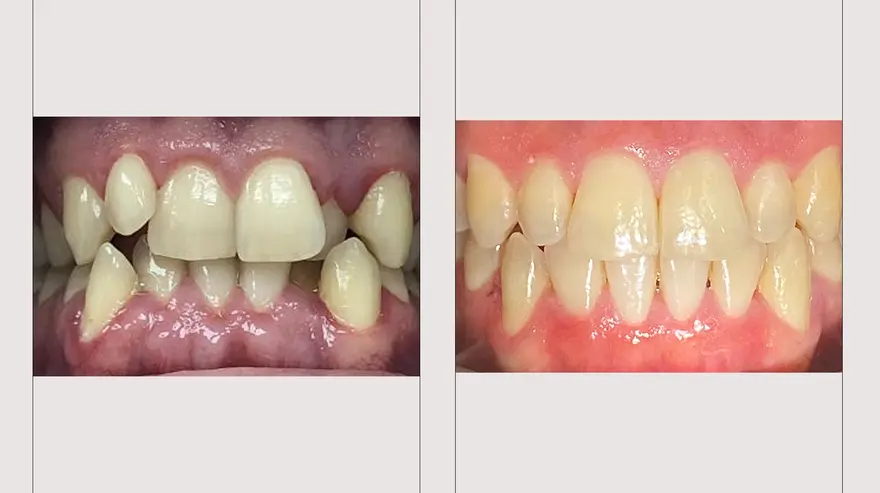 Malocclusion (Before & After)