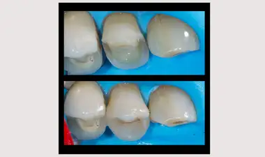 Inlays and Onlays Image