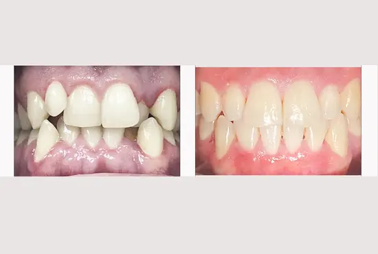 Ceramic Braces Before and After Photos