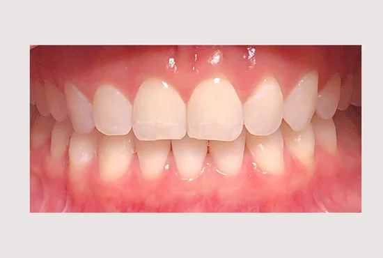 Lingual Braces