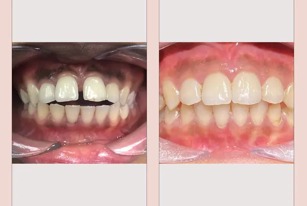 Before and After Invisalign
