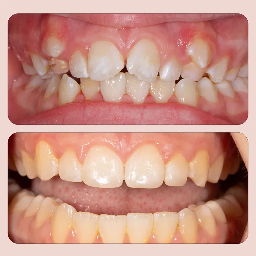 Before and After Impacted Tooth Treatment