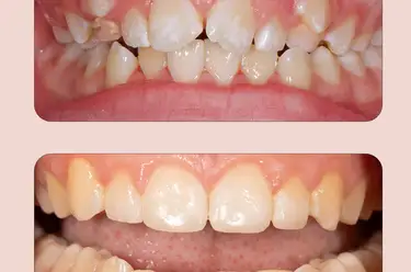 Impacted Tooth Treatments & Definition Image