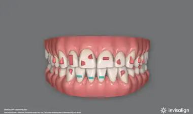 Invisalign Image