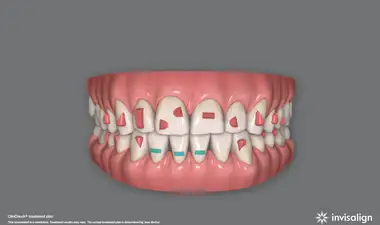 Invisalign Image