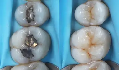 White fillings Image