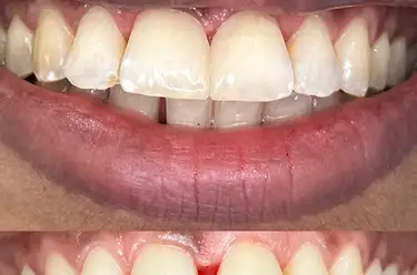 Overbite: Definition & Treatment Image