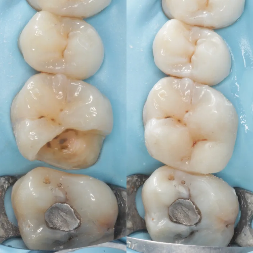 Posterior composite filling