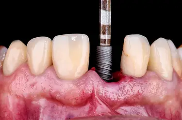 How Much Does a Dental Implant Cost? Image