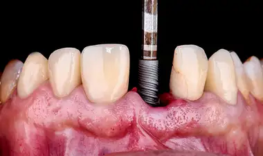 Single Tooth Implants Image