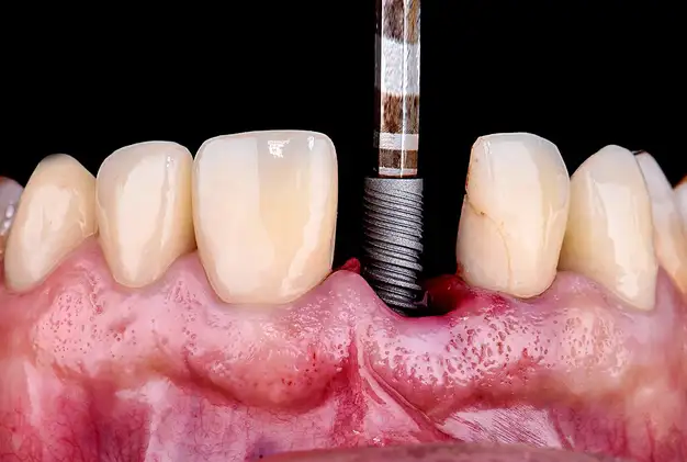 Dental Implants