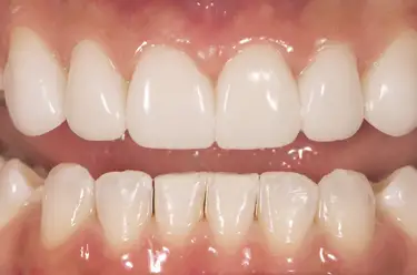 How Much Does a White Filling Cost in the UK? Image