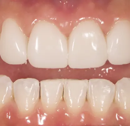 New Teeth after Orthodontics Treatment